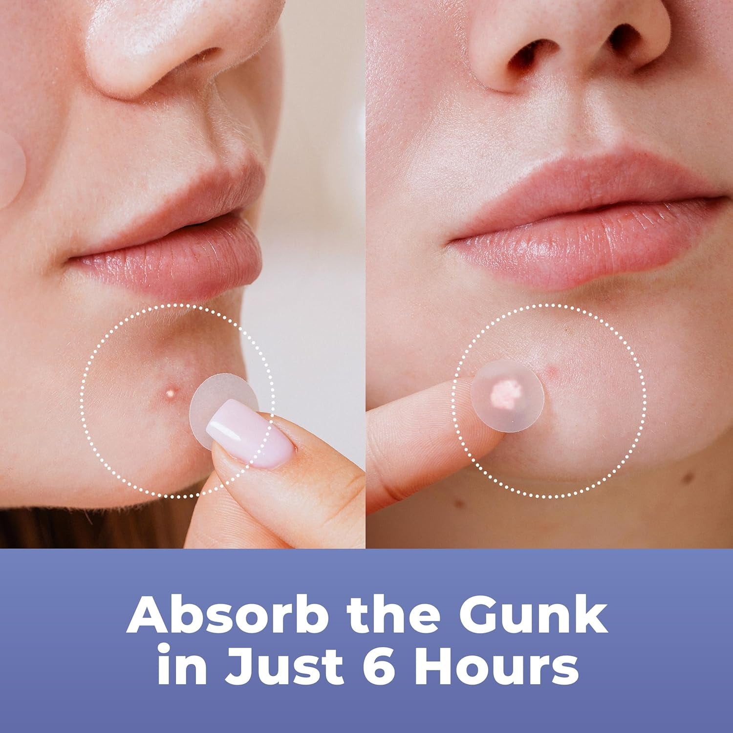 Salicylic Pimple Patches (120 Pack), Salicylic Acid Acne Patches with Tea Tree Oil - Zit Patch and Pimple Stickers for Face for Skin Care - Salicylic Acid Acne Dots (Packaging May Vary)